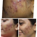 MDW-Acene treatment _ Active acene removal by laser _ Fraction laser treatment _ Hair transplant case _ Fue treatment - MDW Centre