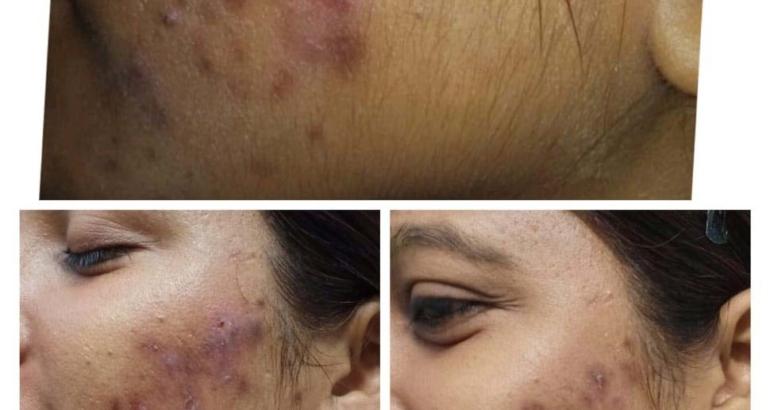 Acne Treatment | Active Acne Removal By Laser | Fraction Laser Treatment