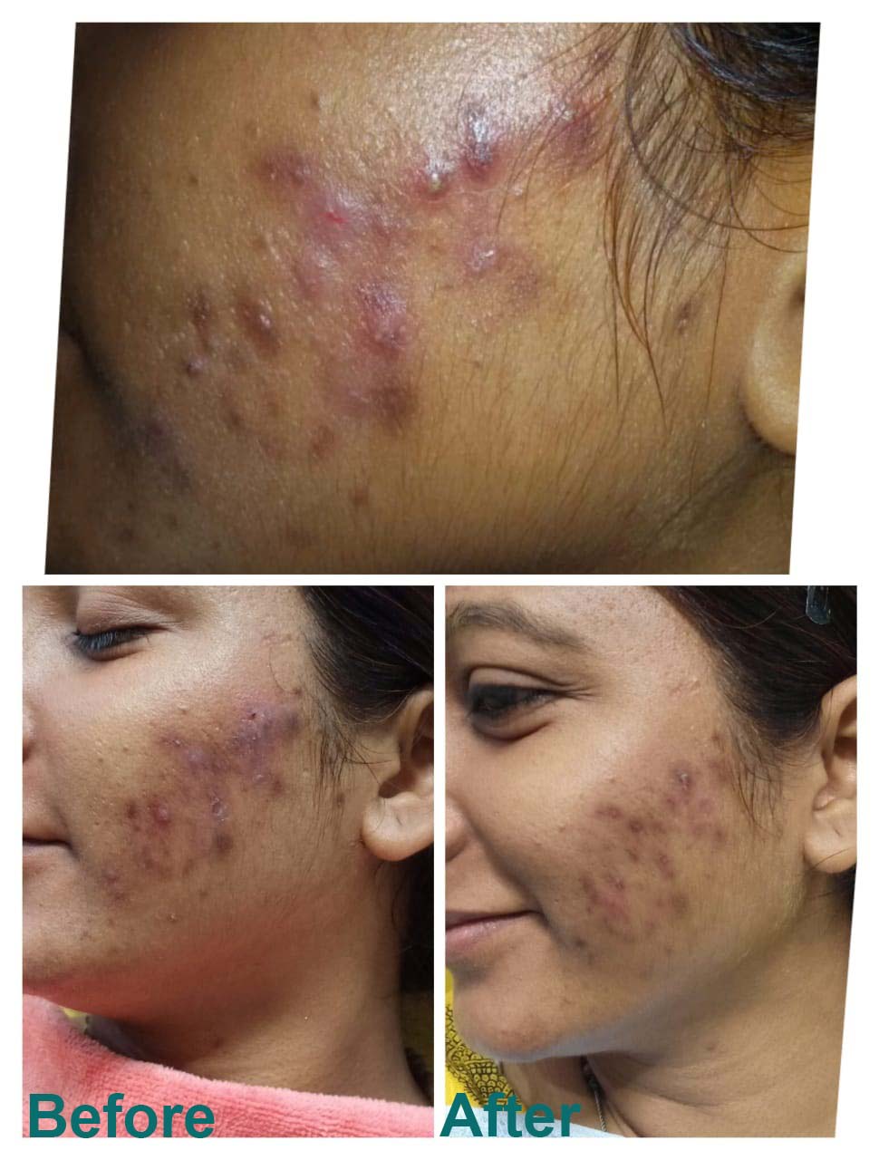 MDW-Acene treatment _ Active acene removal by laser _ Fraction laser treatment _ Hair transplant case _ Fue treatment - MDW Centre