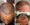 MDW-Hair Transplant Case | Fue Treatment