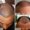 MDW-Hair Transplant Case | Fue Treatment