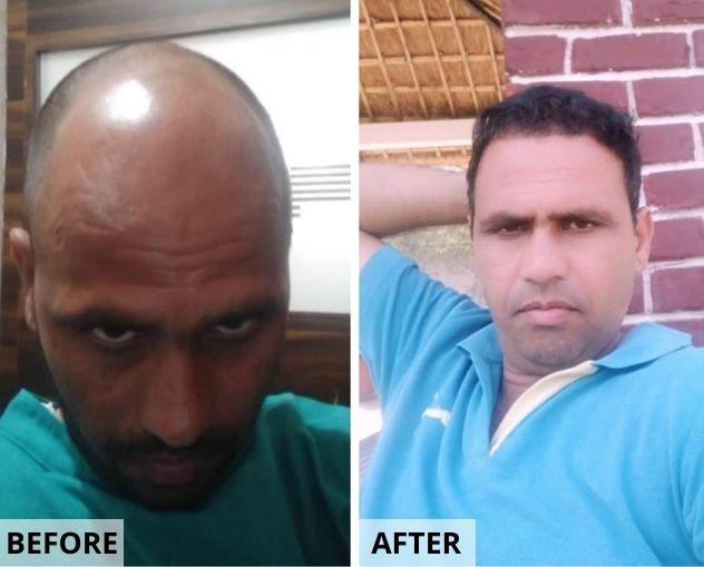 MDW-Hair Transplant Case | Fue Treatment