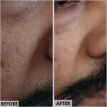 MDW-Before & After-Open Pore Removal | AceneScar Removal - MDW Centre