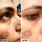 MDW-Before & After-Pigmentation Treatment | Melasma Treatment | Skin Spots Treatment | Fraction lasers - MDW Centre MDW-Before & After-Pigmentation Treatment | Melasma Treatment | Skin Spots Treatment | Fraction lasers