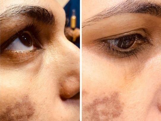 MDW-Before & After-Pigmentation Treatment | Melasma Treatment | Skin Spots Treatment | Fraction lasers