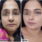 MDW-Before & After-Skin Lightening & Anti Aging Treatment | Facial Fat Removal | Skin Rejuvenation - MDW Centre