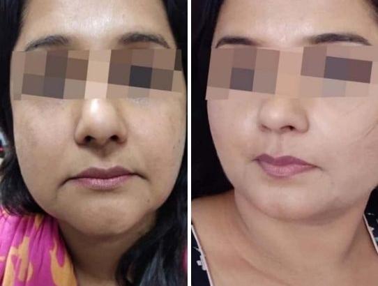 Before and After: Skin Lightening & Anti Aging Treatment | Facial Fat Removal | Skin Rejuvenation