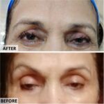 MDW-Before & After-Undereye Treatment | Undereye Toning | Skin Lightening - MDW Centre MDW-Before & After
