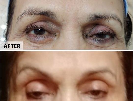 Under Eye Treatment | Under Eye Toning | Skin Lightening
