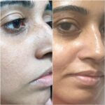 Photofacial | Vampire Peel | Co2 Carbon Facial | Q Switch Ndyag Laser - MDW Centre MDW-Before & After