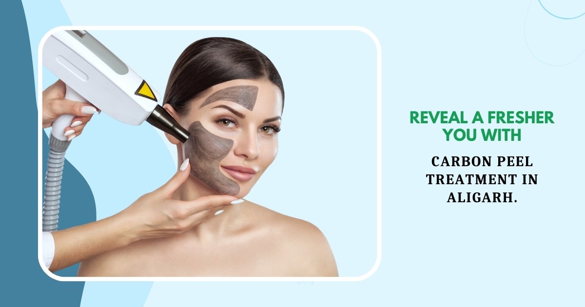 MDW Centre - Carbon Peel treatment in Aligarh