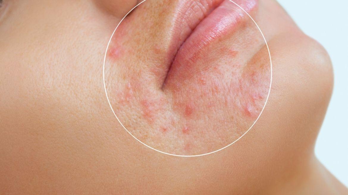 MDW-Centre-ACNE-Treatment