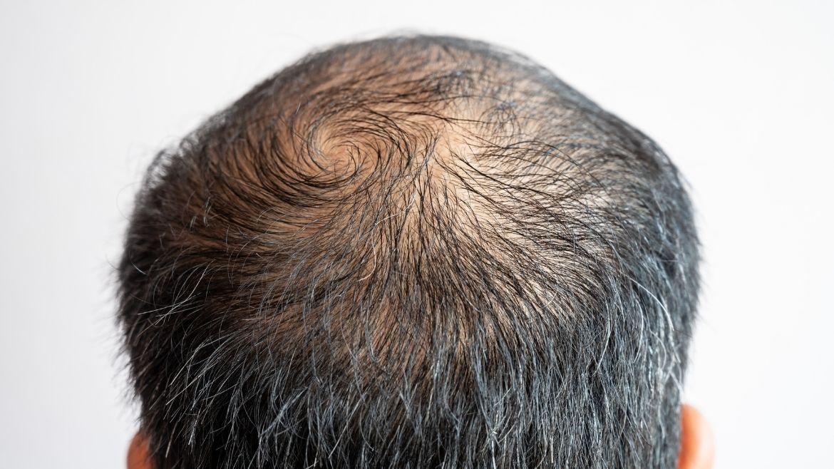 Hair Loss - MDW Centre