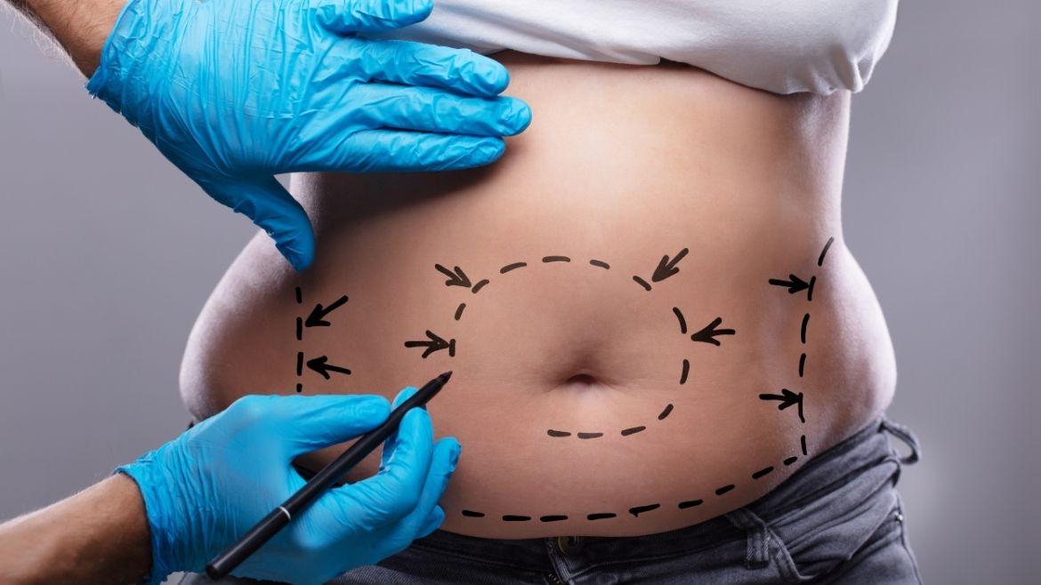 MDW-Centre-LIPOSUCTION