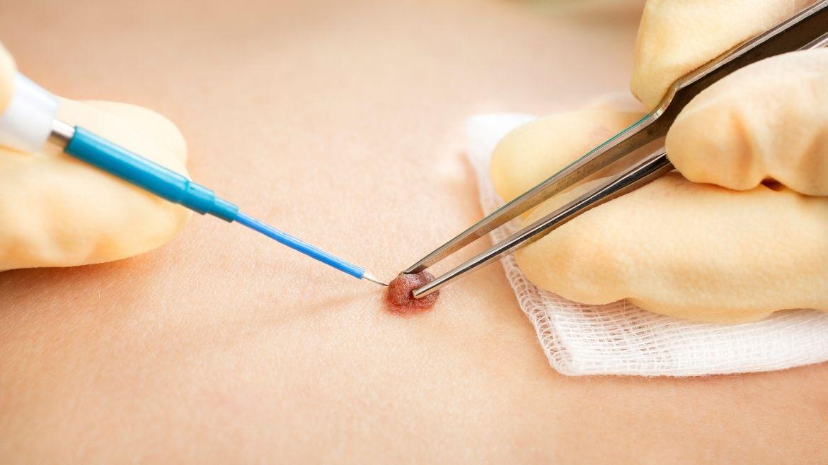 MDW-Centre-MOLE-REMOVAL-WART-REMOVAL-SURGERY - MDW Centre MDW-Centre-MOLE-REMOVAL-WART-REMOVAL-SURGERY