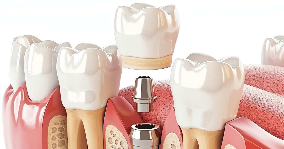 MDW Centre - Transform Your Smile with Orthodontic Treatment in Aligarh