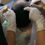 MDW Centre - Restore Your Hairline Naturally with Hair Transplant in Aligarh - MDW Centre MDW Centre - Restore Your Hairline Naturally with Hair Transplant in Aligarh
