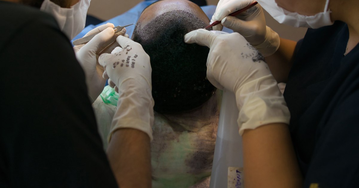 MDW Centre - Restore Your Hairline Naturally with Hair Transplant in Aligarh