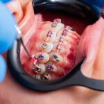 MDW Centre - Best Orthodontic Treatment in Aligarh for Misaligned Teeth - MDW Centre
