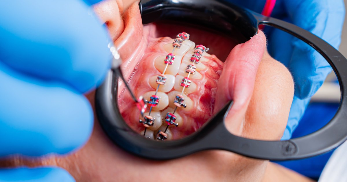 MDW Centre - Best Orthodontic Treatment in Aligarh for Misaligned Teeth - MDW Centre