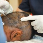 MDW Centre - Hair Transplant in Aligarh Made Easy with Expert Care - MDW Centre MDW Centre - Hair Transplant in Aligarh Made Easy with Expert Care