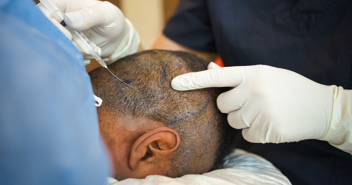 MDW Centre - Hair Transplant in Aligarh Made Easy with Expert Care