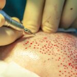 MDW Centre - Restore Your Confidence With A Hair Transplant In Aligarh - MDW Centre