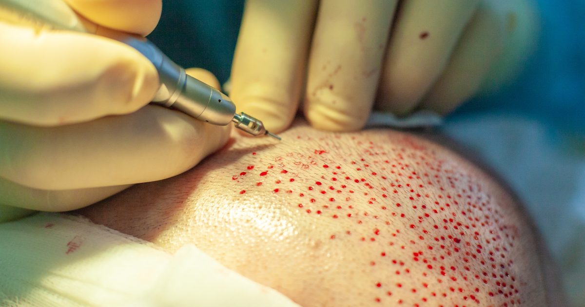 MDW Centre - Restore Your Confidence With A Hair Transplant In Aligarh - MDW Centre