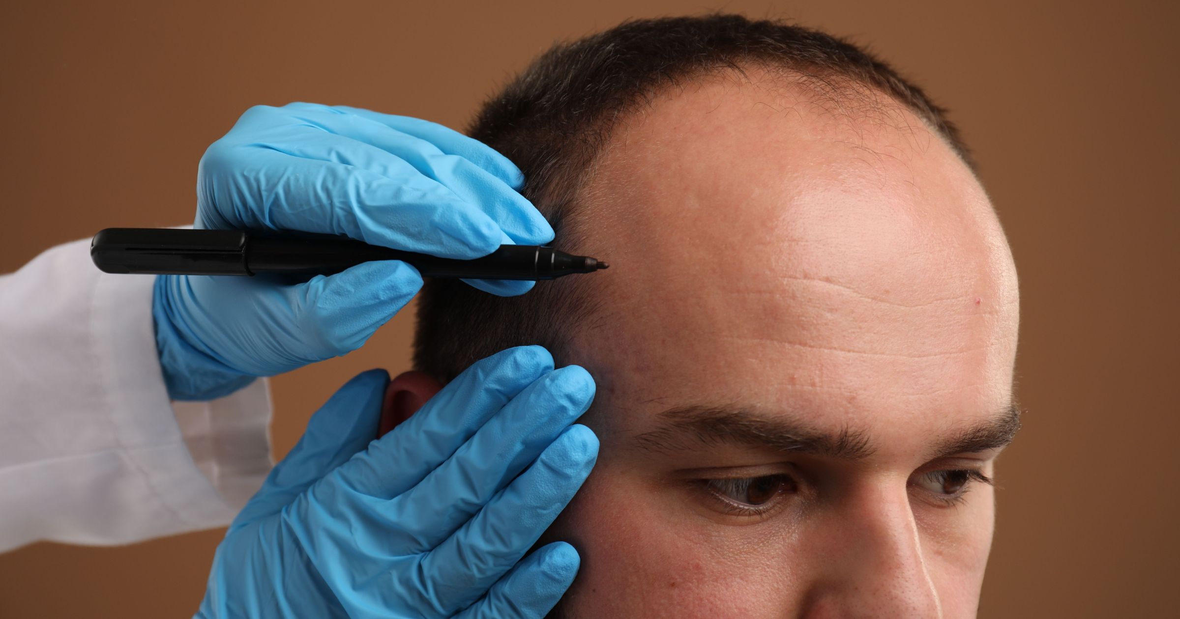 Affordable Hair Transplant in Aligarh Clinic Guide - MDW Centre Affordable Hair Transplant in Aligarh Clinic Guide