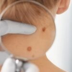 MDW Centre - Best Dermatologist in Aligarh for Hair Treatment