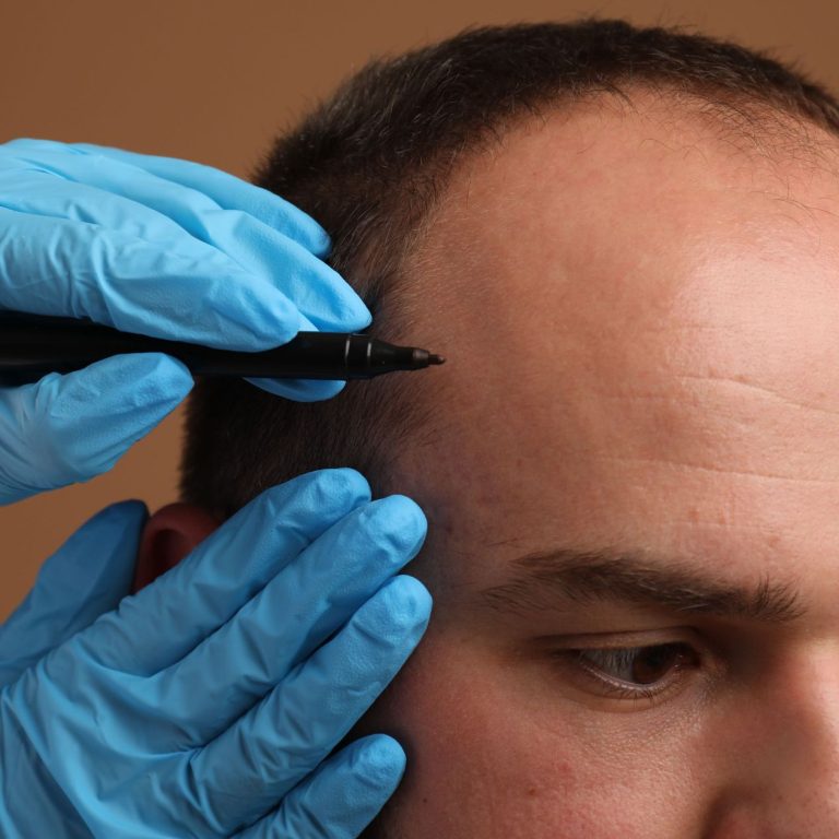 Affordable Hair Transplant in Aligarh Clinic Guide