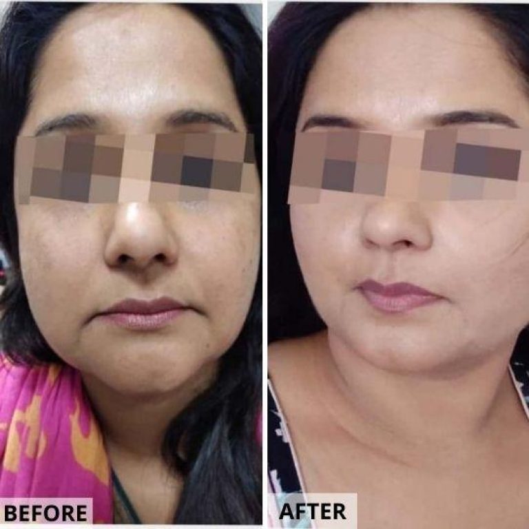MDW-Before & After-Skin Lightening & Anti Aging Treatment | Facial Fat Removal | Skin Rejuvenation
