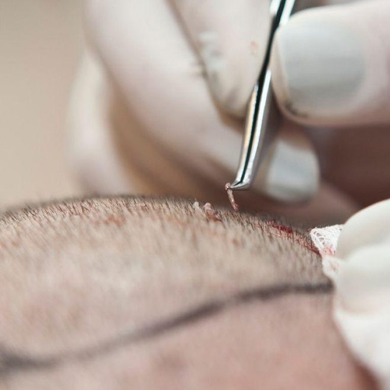 MDW-CENTRE-HAIR-TRANSPLANT