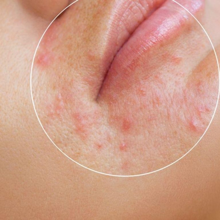 MDW-Centre-ACNE-Treatment