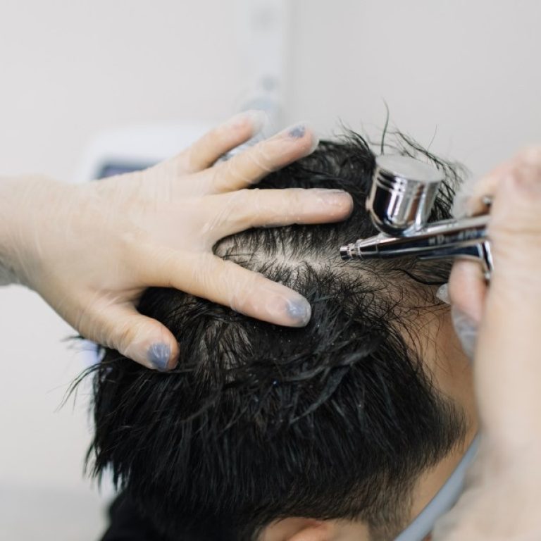 MDW Centre - Advanced Hair Loss Solutions with Hair Treatment in Aligarh