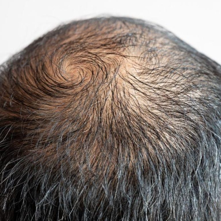 MDW-Centre-Hair-Loss