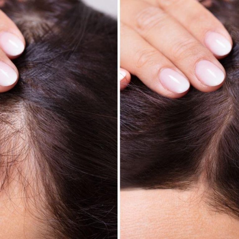 MDW-Centre-Hair-Regrow