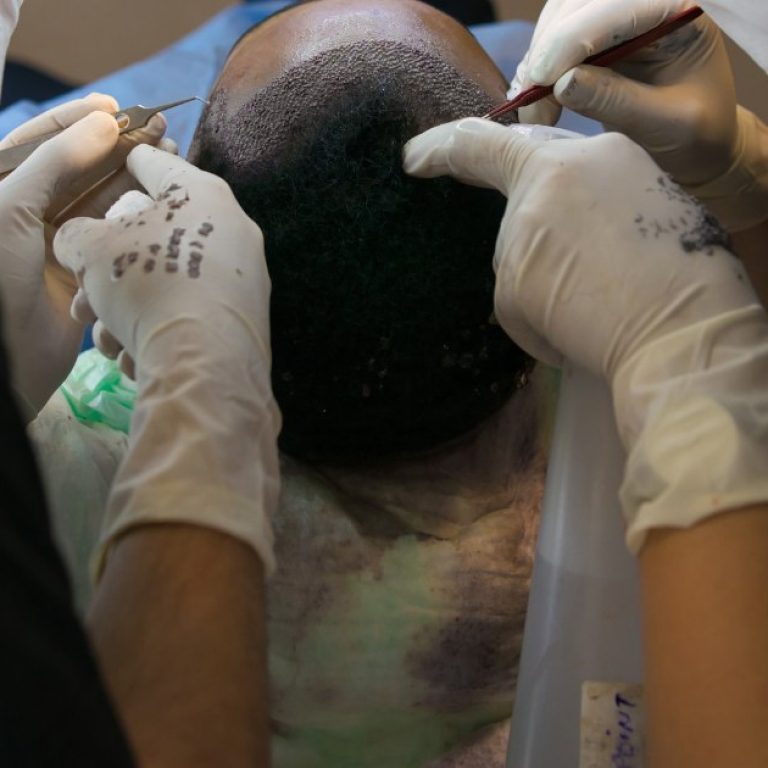 MDW Centre - Restore Your Hairline Naturally with Hair Transplant in Aligarh